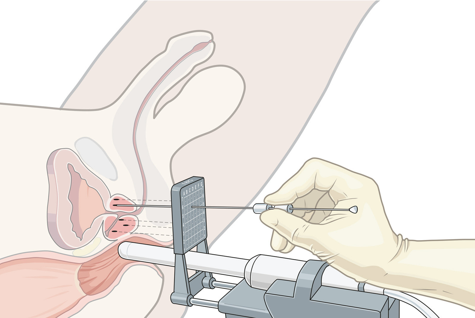 oculus-illustration-medizin-prostata