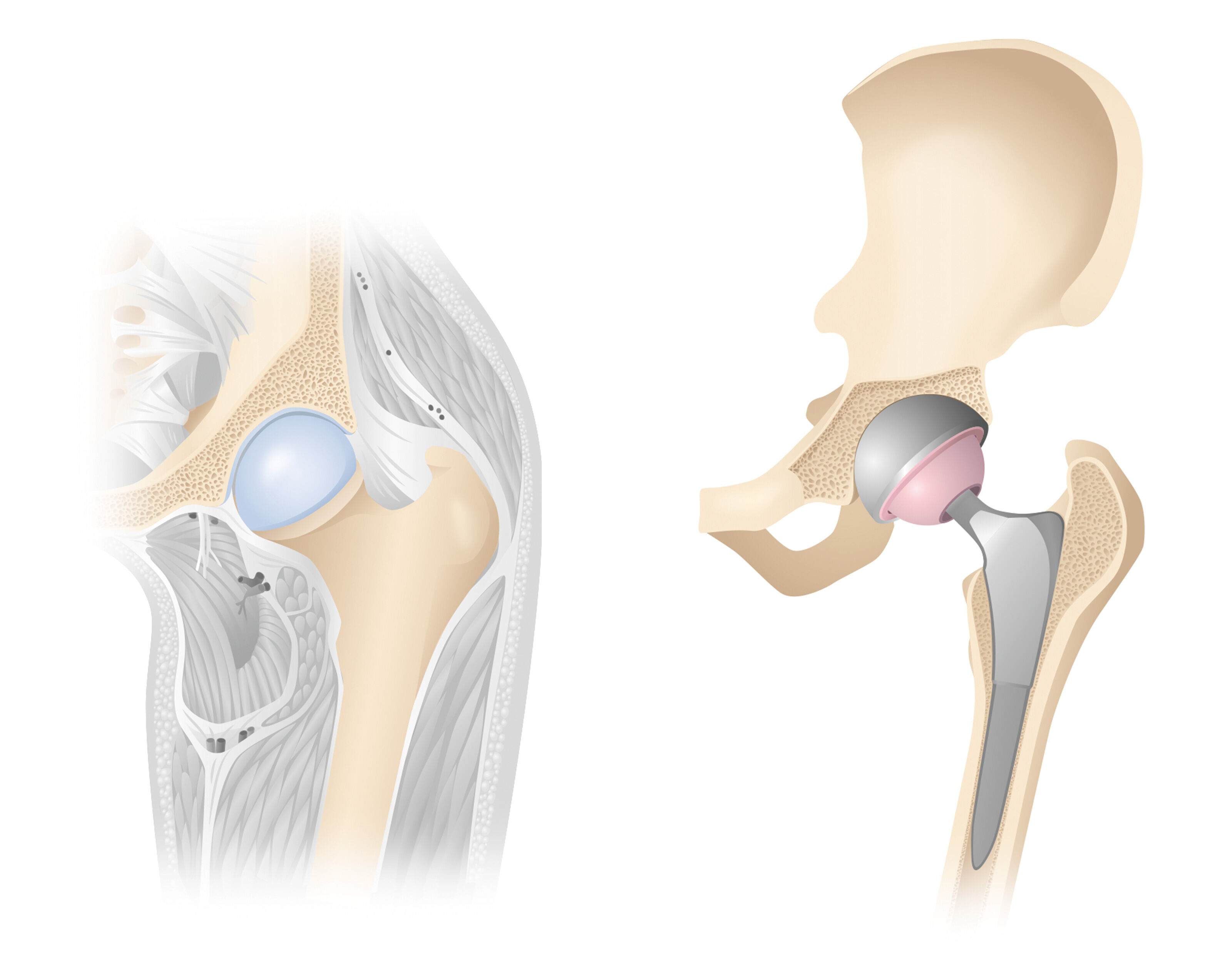 oculus-illustration-medizin-gelenkchirurgie-huefte-prothese
