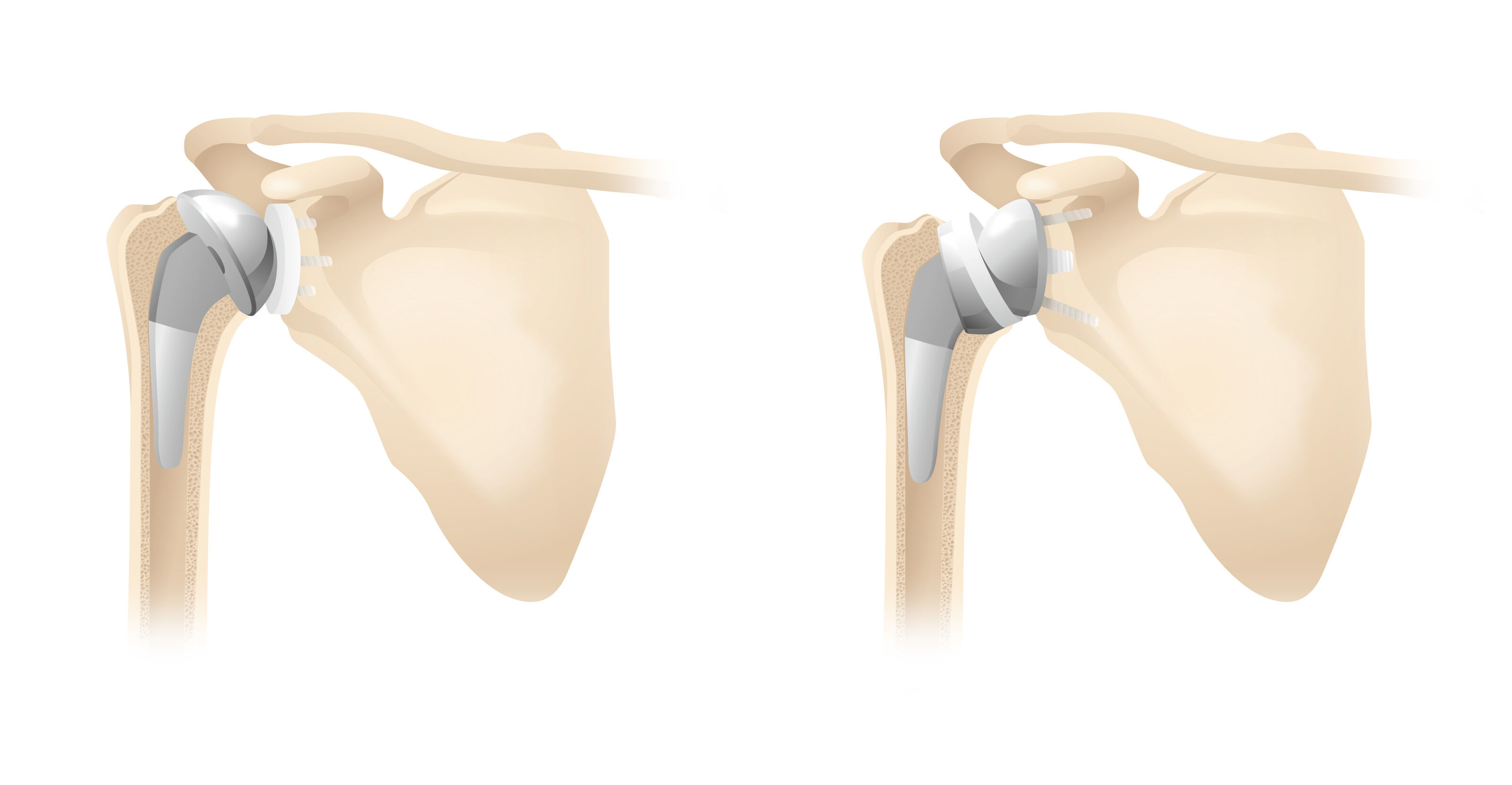 oculus-illustration-medizin-gelenkchirurgie-schulter-prothese